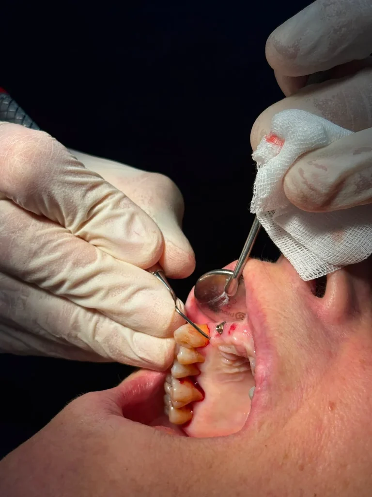 Tratamiento de las encías en ML Clínica Dental