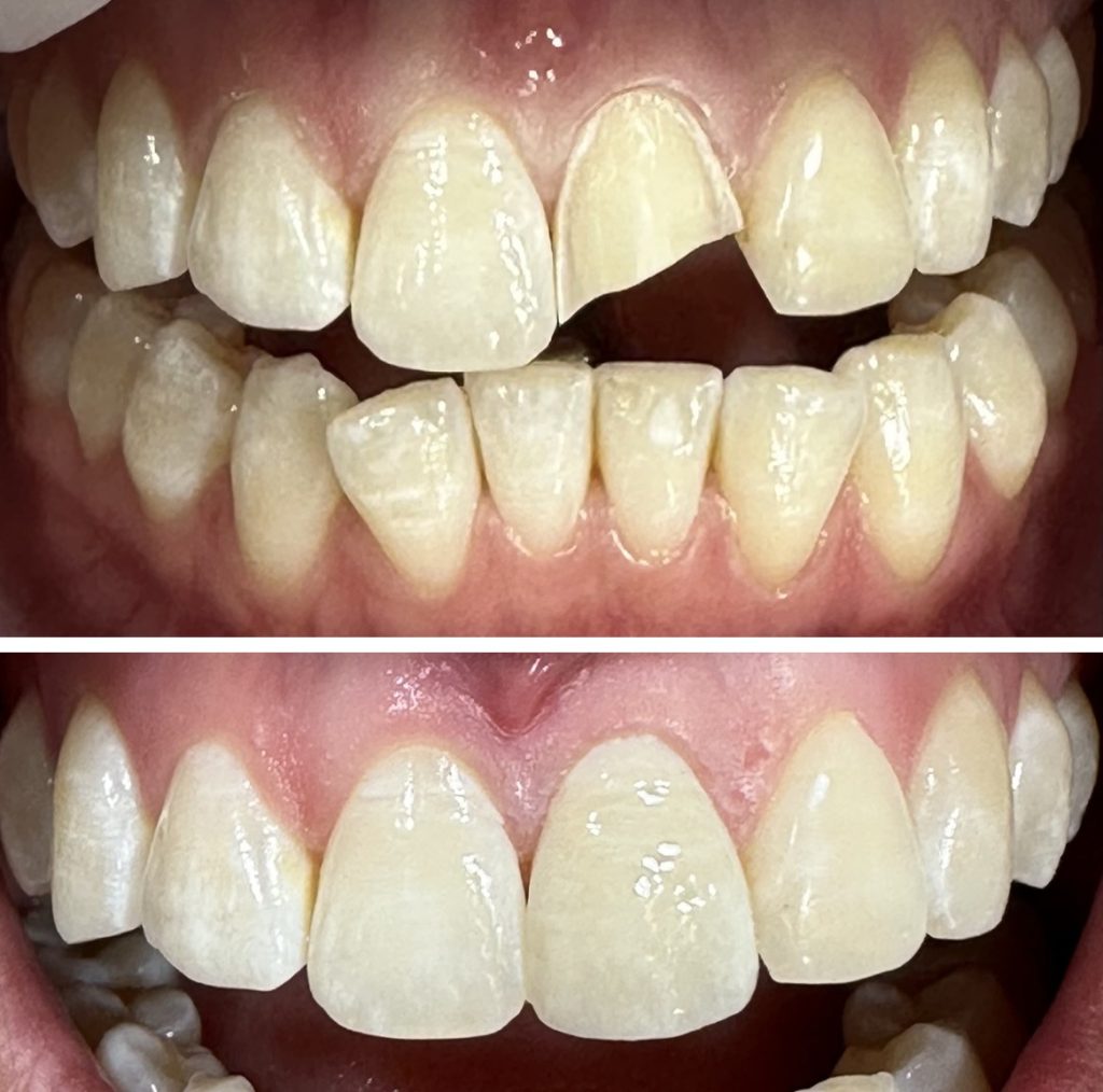 Estética dental antes y después en Badalona