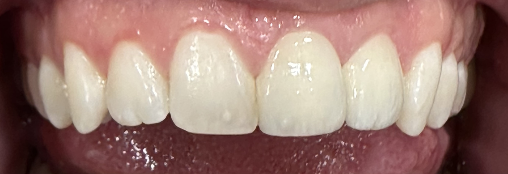 Resultado de estética dental en Badalona