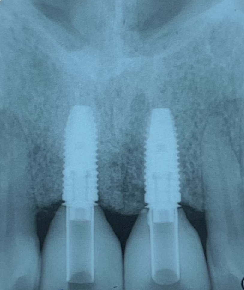 Radiografía de implantes dentales en Badalona