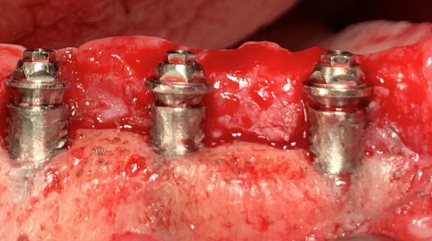 Mantenimiento de implantes en Badalona