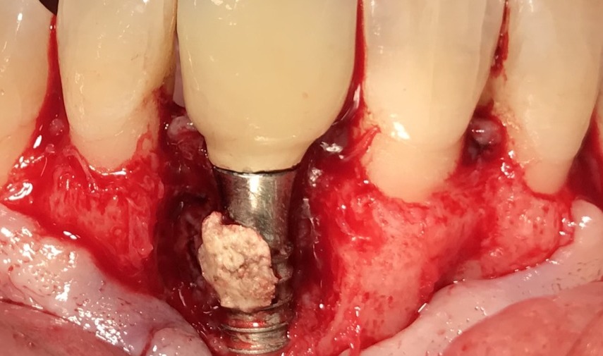 Caso de mantenimiento de implantes en Badalona